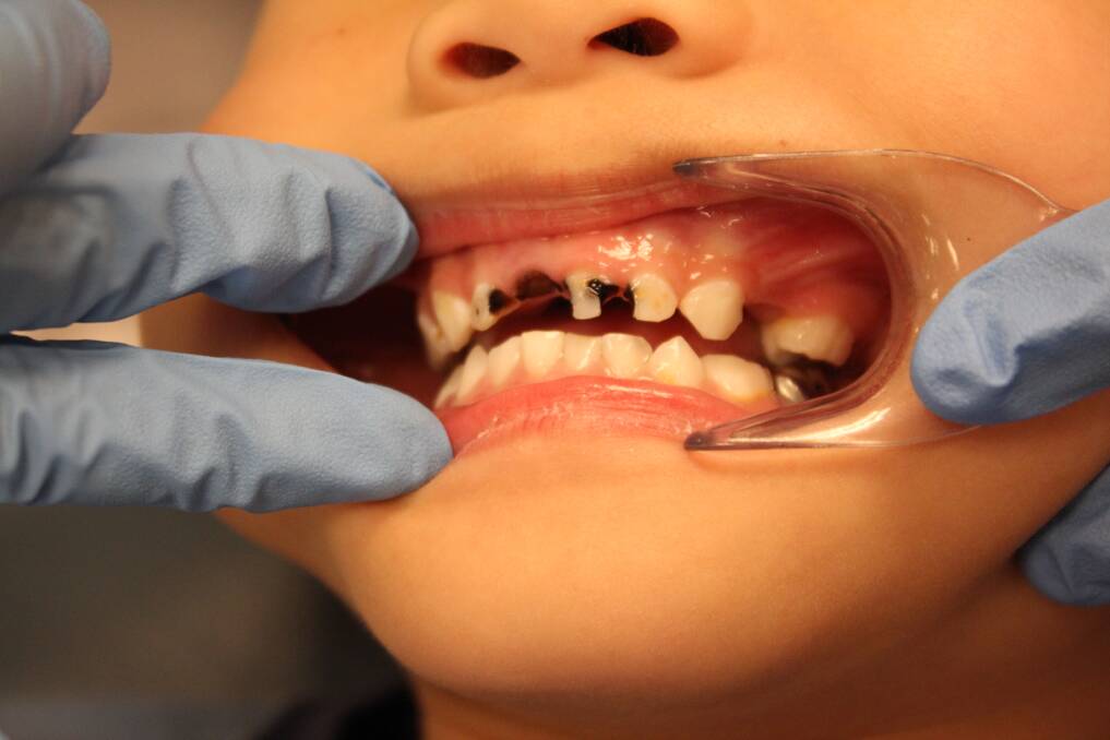 Tooth decay rates high in the region