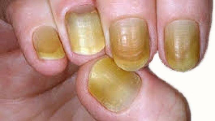 The man involved in the Bundoora attack had distinctive yellow nails like this. Photo: Victoria Police