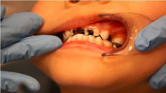 Why our kids have a high rate of dental decay | Family Matters